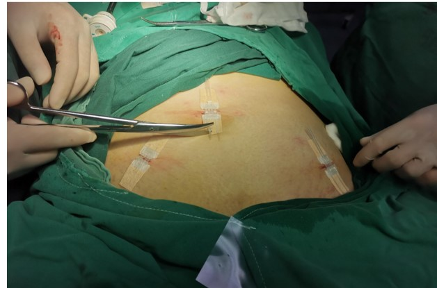 闭合器使用场景