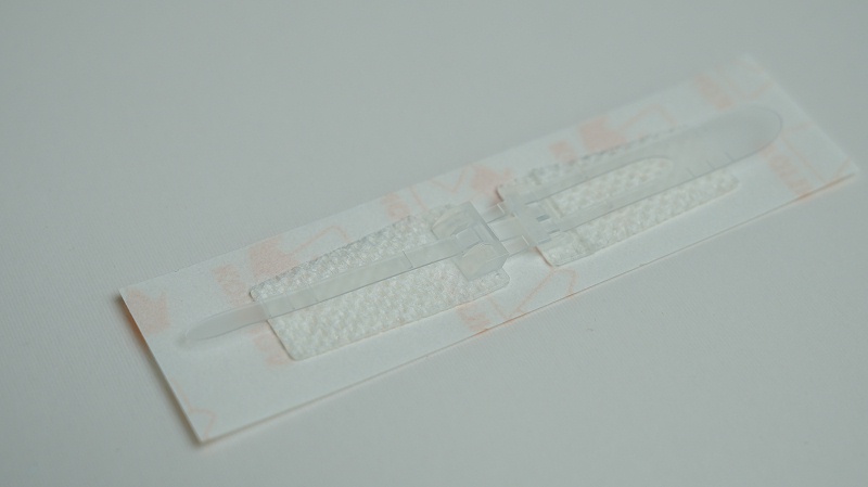 单扣免缝闭合器